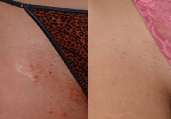 Laser Hair Removal Before & After Gallery