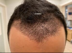 After Image: Hair Restoration