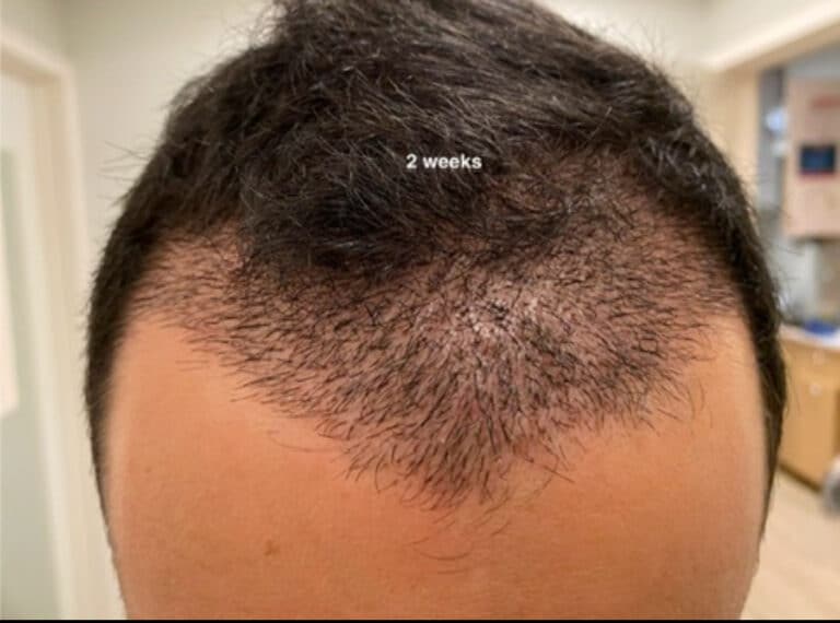 After Image: Hair Restoration - front