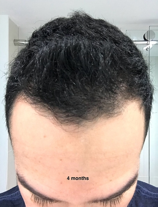Before Image: Hair Restoration - front