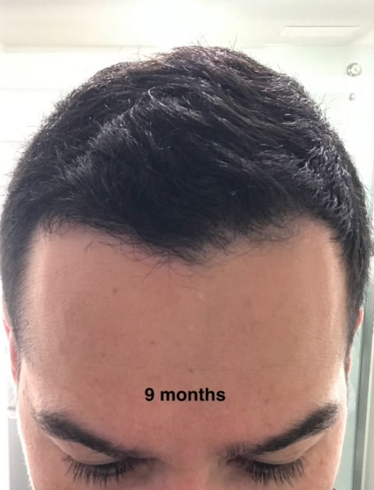 After Image: Hair Restoration - front