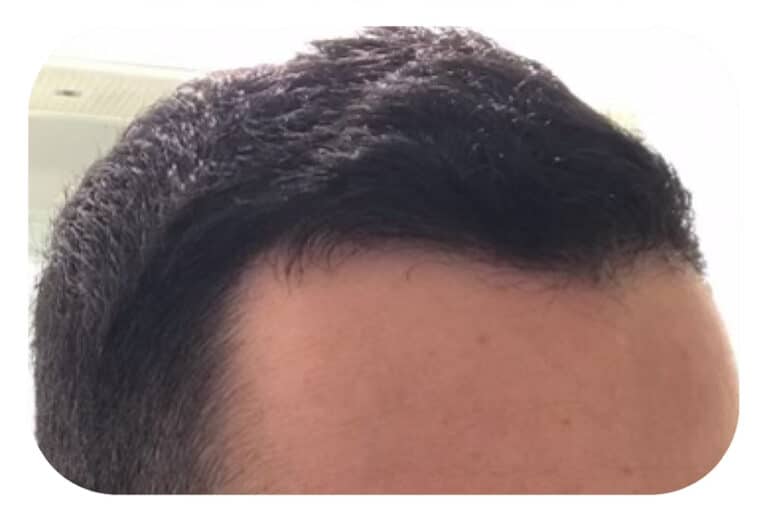 After Image: Hair Restoration - right-front-oblique