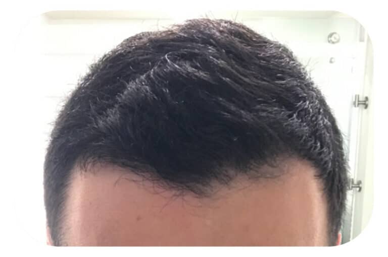 After Image: Hair Restoration - front