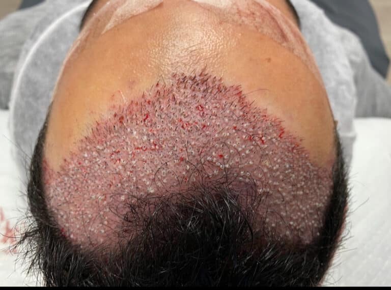 Before Image: Hair Restoration - front