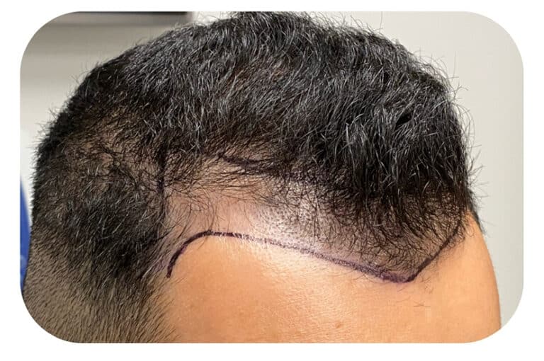 Before Image: Hair Restoration - right-front-oblique