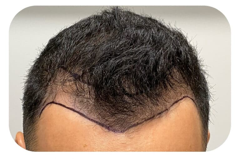Before Image: Hair Restoration - front