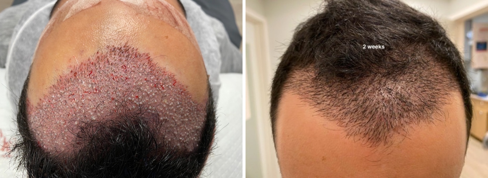 Smartgraft Hair Restoration Panama City Beach FL