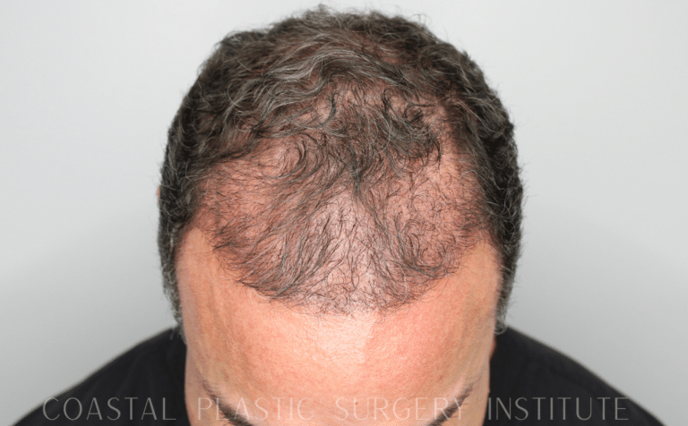 After Image: Hair Restoration - front