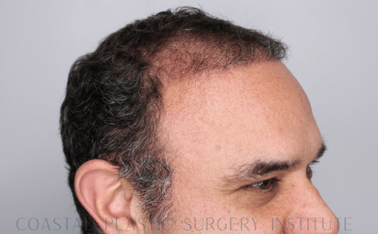 After Image: Hair Restoration - right-front-oblique