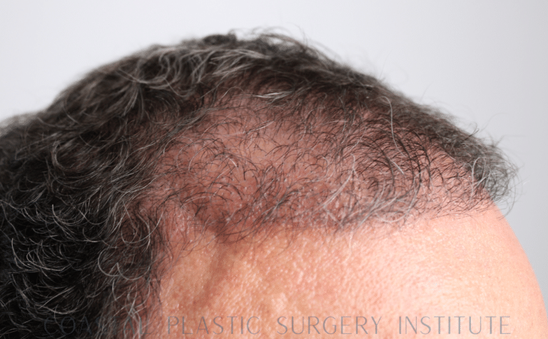 After Image: Hair Restoration - right-front-oblique