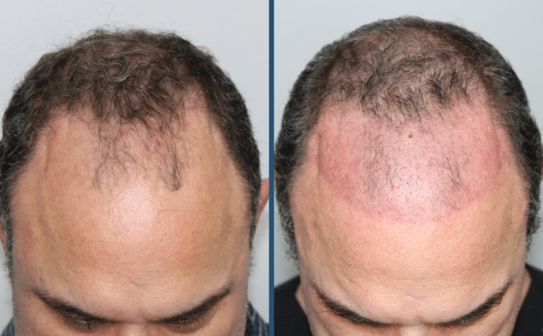 Before Image: Hair Restoration - front