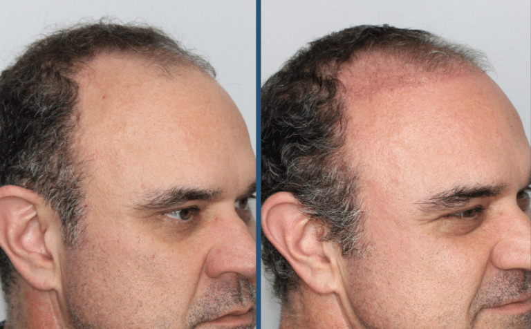 Before Image: Hair Restoration - right-front-oblique
