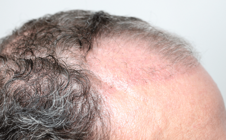 Before Image: Hair Restoration - right-front-oblique