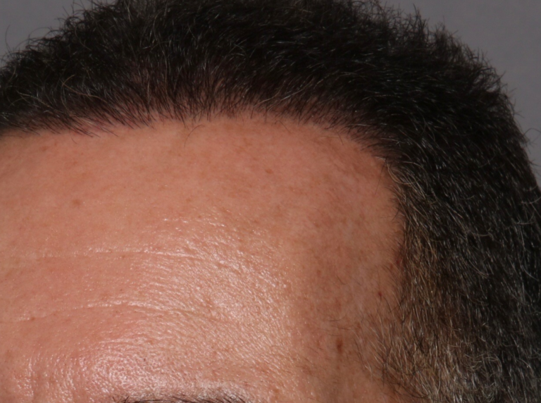After Image: Hair Restoration - front