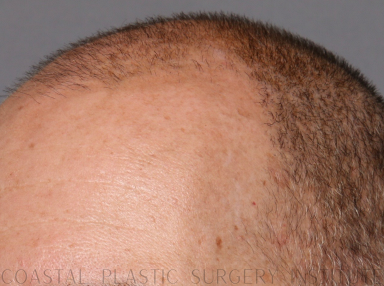 Before Image: Hair Restoration - front