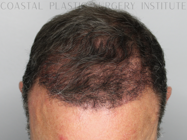 After Image: Hair Restoration - front