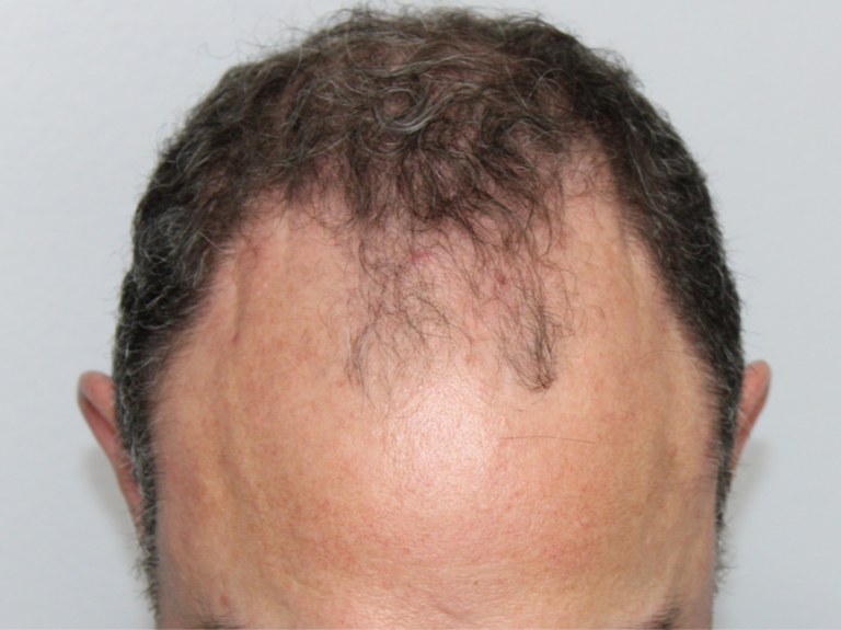 Before Image: Hair Restoration - front