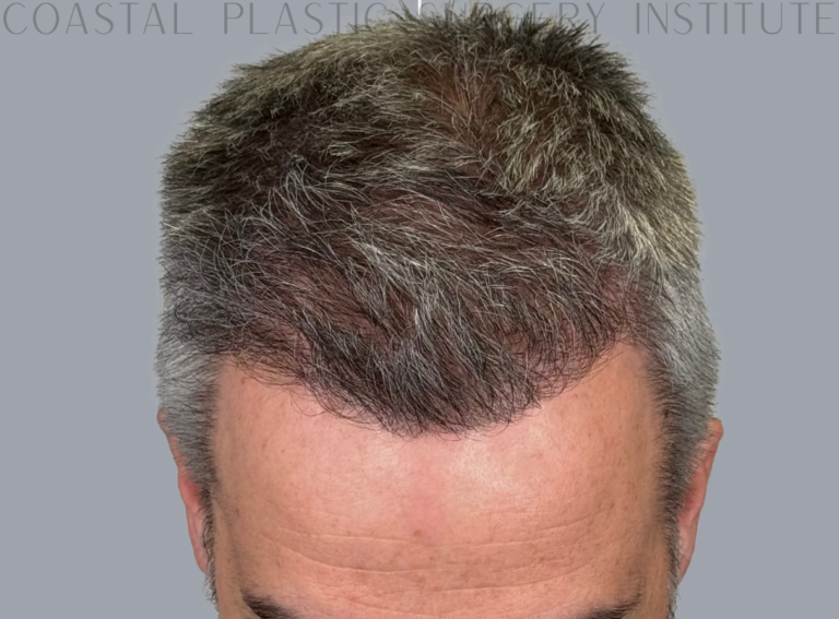 After Image: Hair Restoration - front