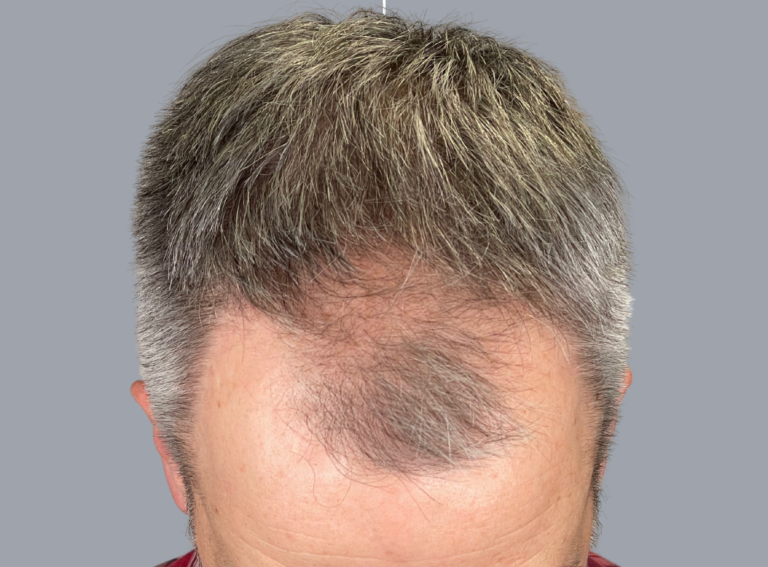 Before Image: Hair Restoration - front