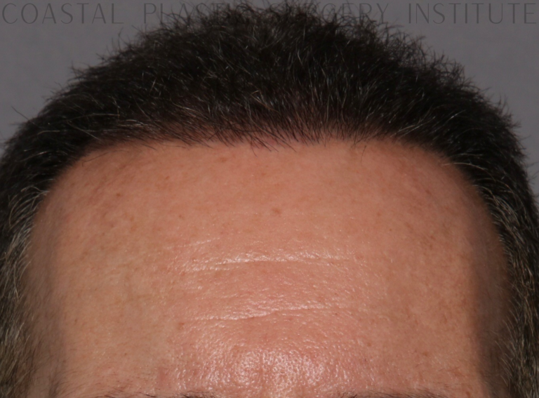 After Image: Hair Restoration - front