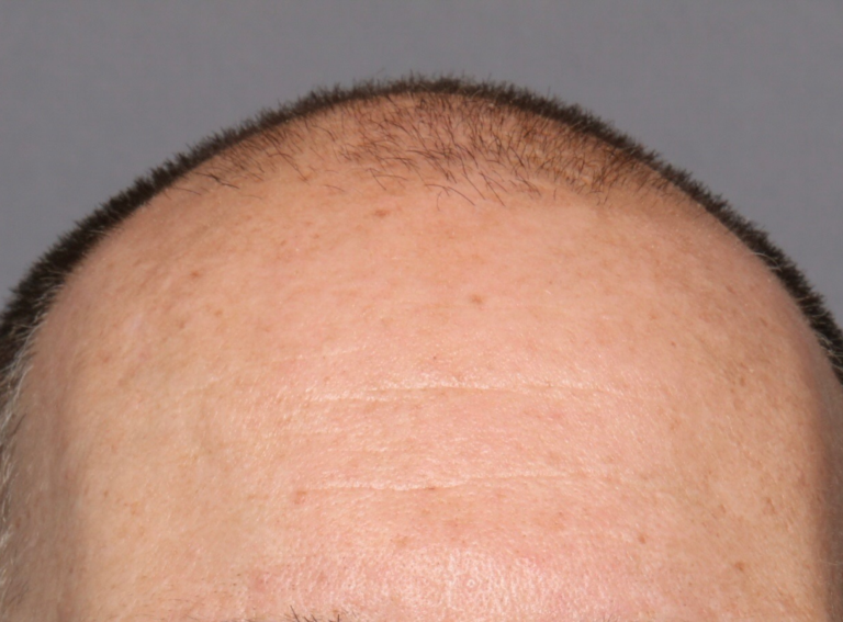 Before Image: Hair Restoration - front
