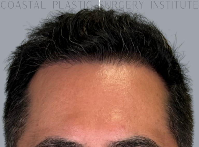 After Image: Hair Restoration - front