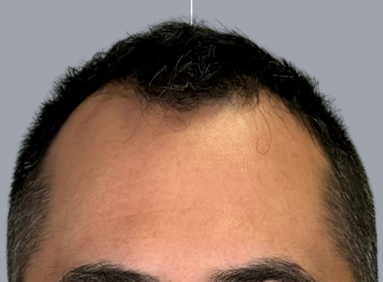Before Image: Hair Restoration - front