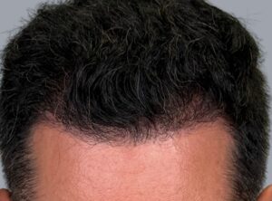 After Image: Hair Restoration