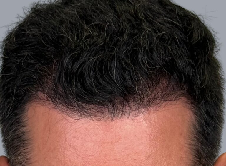 After Image: Hair Restoration - front