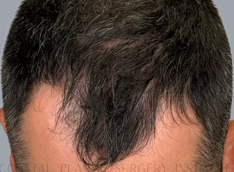Before Image: Hair Restoration - front