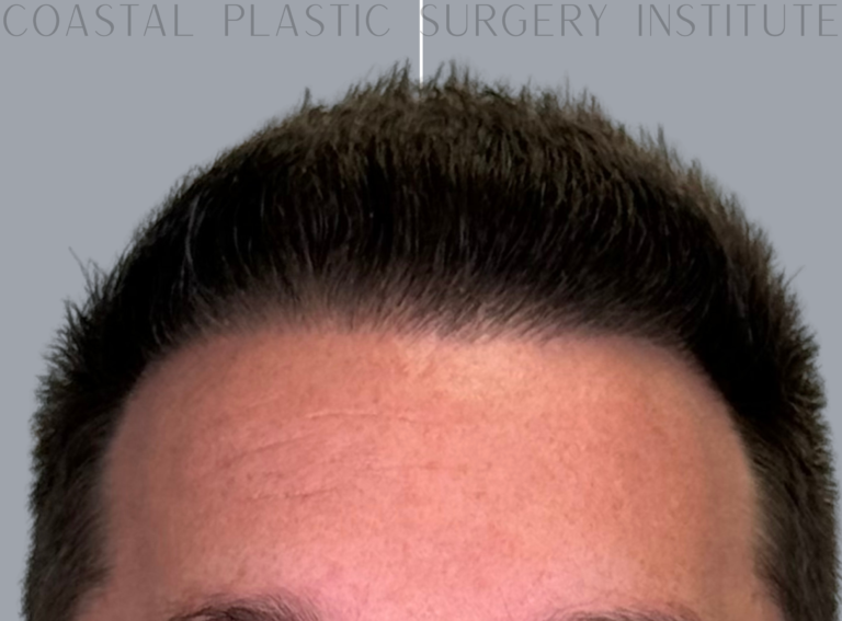 After Image: Hair Restoration - front