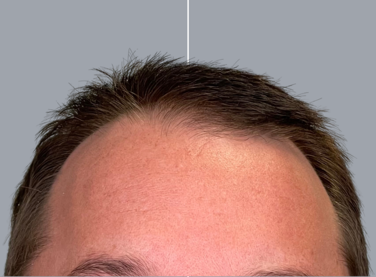 Before Image: Hair Restoration - front