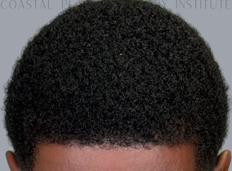 After Image: Hair Restoration - front