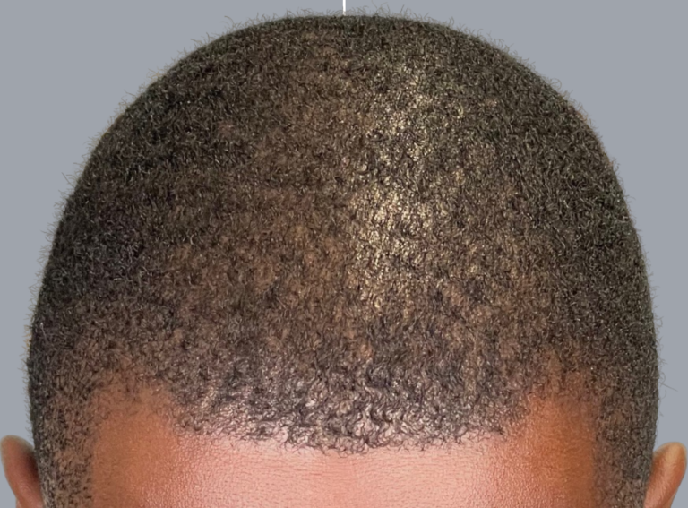 Before Image: Hair Restoration - front
