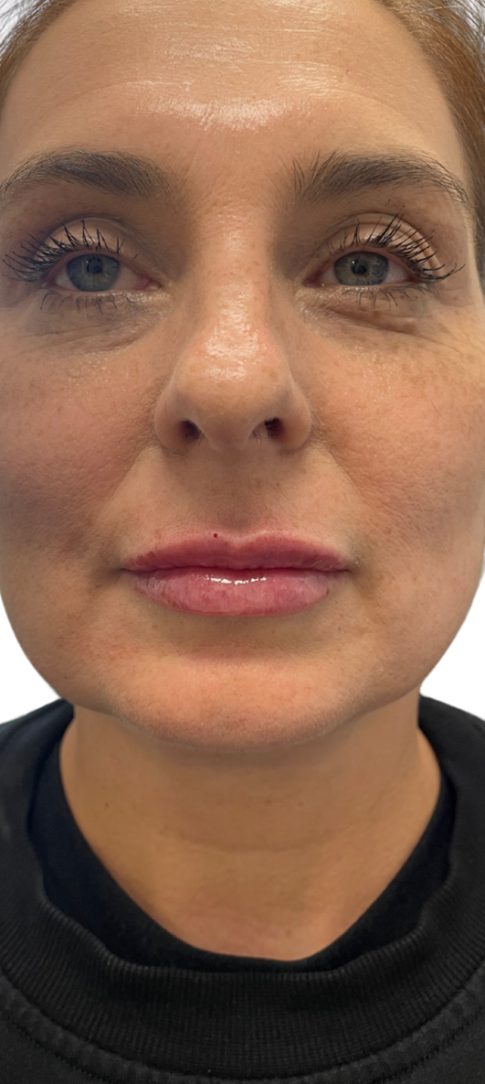 After Image: Lip Filler - front