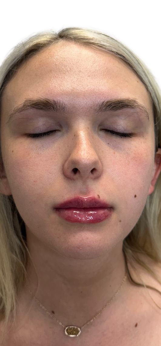 After Image: Lip Filler - front