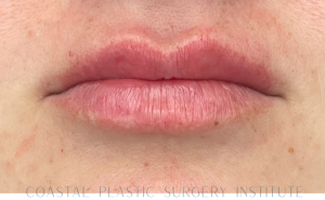 After Image: Lip Filler