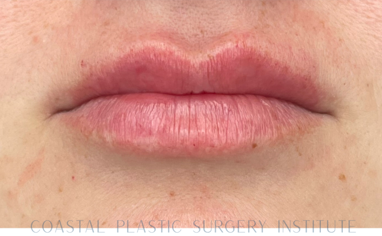 After Image: Lip Filler - front