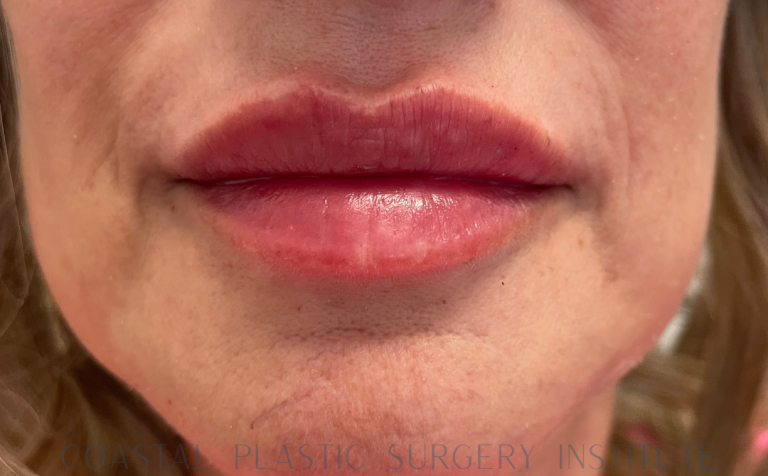 After Image: Lip Filler - front