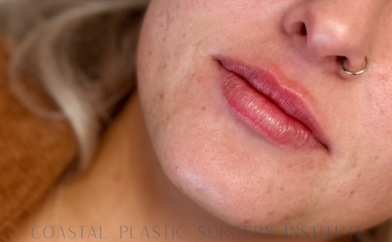 After Image: Lip Filler - front