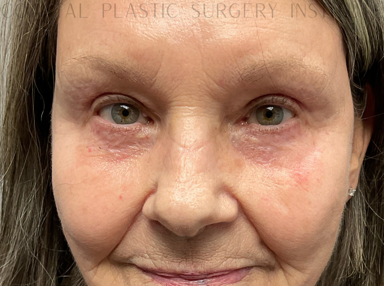 After Image: Eyelid Surgery - front