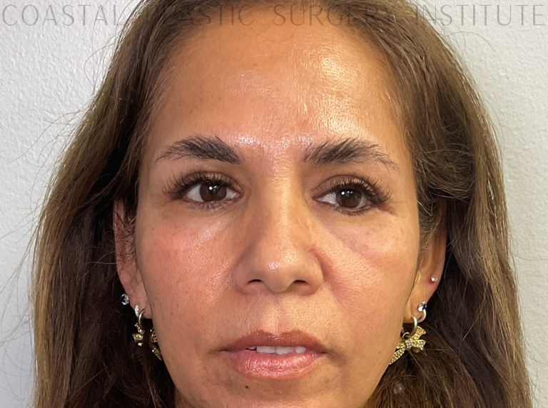 After Image: Eyelid Surgery - front
