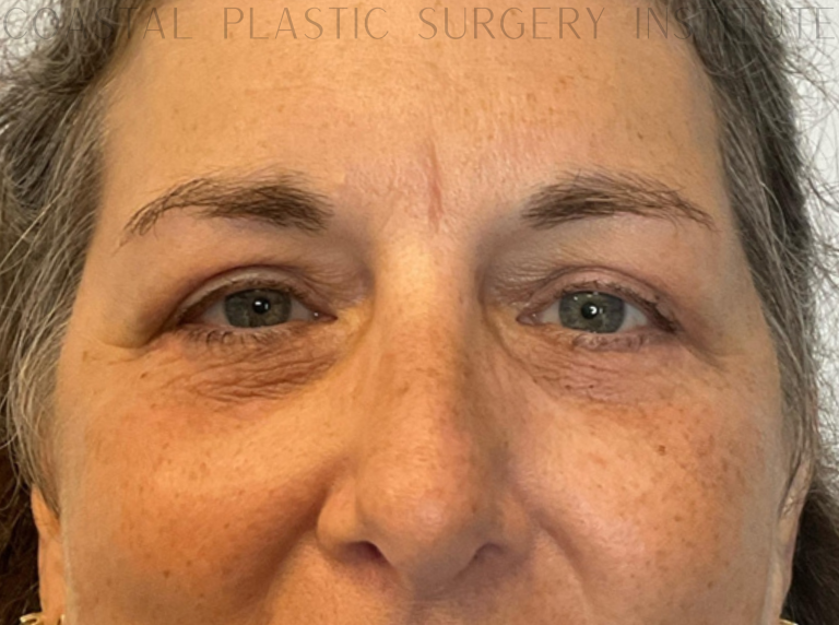 After Image: Eyelid Surgery - front