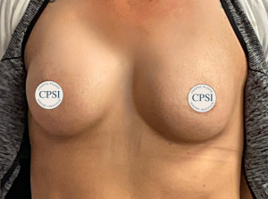 After Image: Breast Augmentation