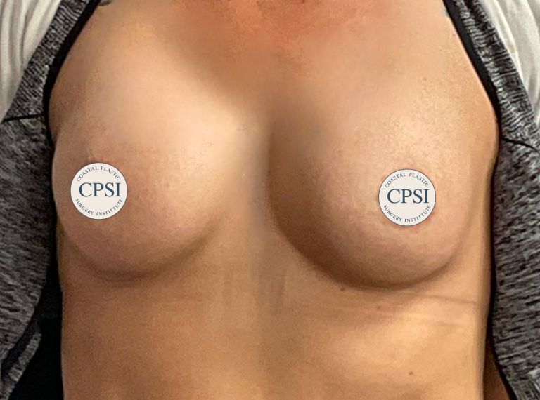 After Image: Breast Augmentation - front