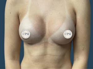 After Image: Breast Augmentation