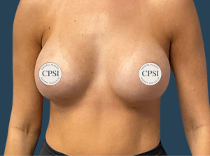 After Image: Breast Augmentation