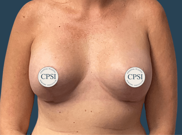 After Image: Breast Lift - front