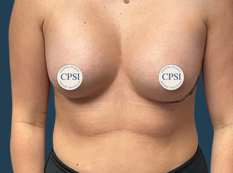 After Image: Breast Augmentation - front