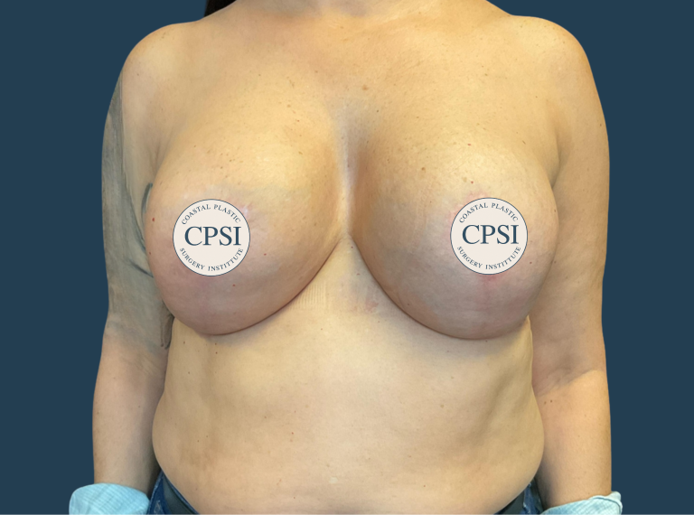 After Image: Breast Lift - front